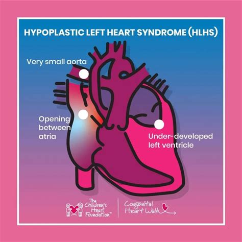 Hypoplastic Left Heart Syndrome Signs Symptoms Support