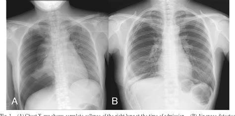 Figure 1 From Incidental Early Lung Adenocarcinoma After Surgery For