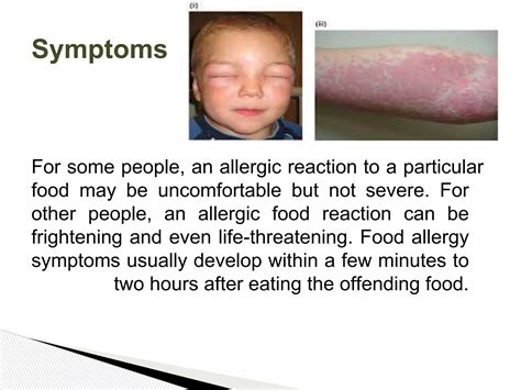 food allergypptx