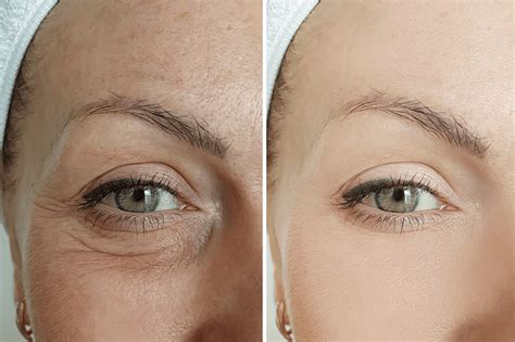 Microneedling Under Eyes What To Consider Pro Needling