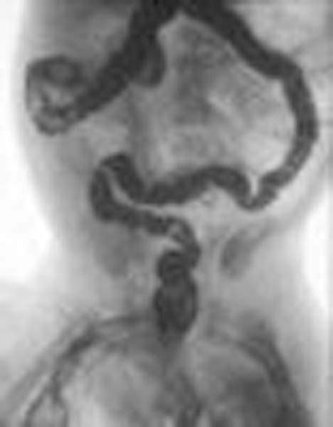 Meconium ileus - wikidoc