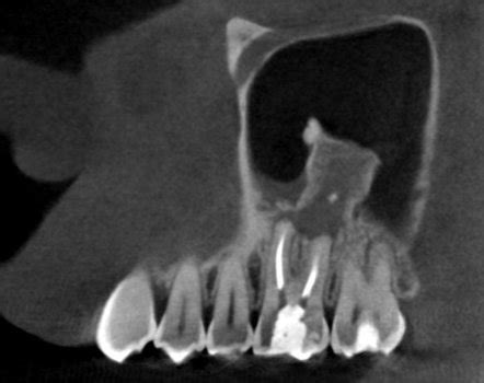 Reactional Osteogenesis In Maxillary Sinus Radiology Case