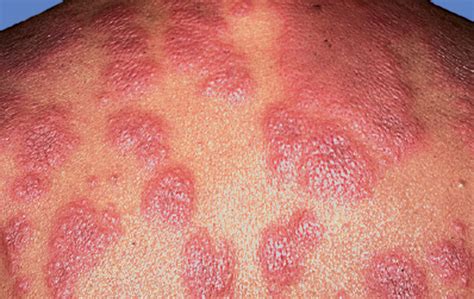 Erythematous Plaques With Fever And Leukocytosis—quiz Case Cardiology Jama Dermatology The