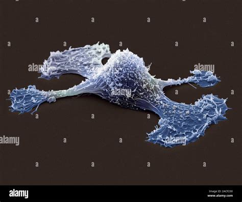 Metastasis Of A Cancerous Cell Coloured Scanning Electron Micrograph Sem Of An Ovarian Cancer