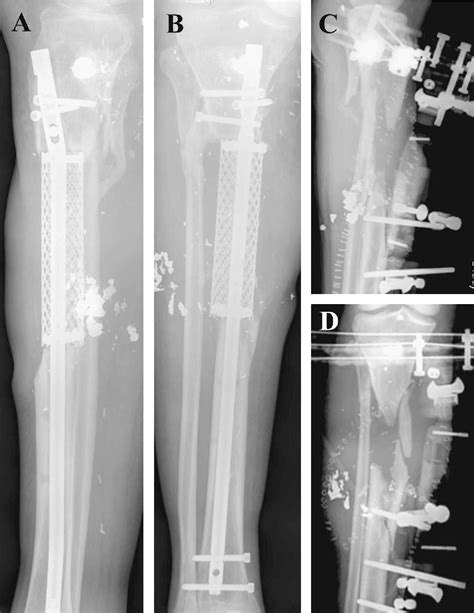 Management Of Large Segmental Tibial Defects Using A Cylindrical Mesh