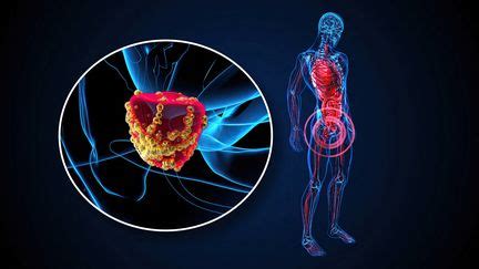 Les Nouveaux Cas De Cancers De La Prostate Vont Doubler D Ici