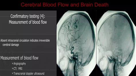 Cerebrovascular Anatomy PPT