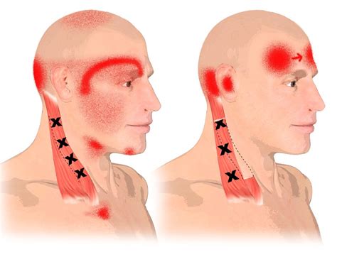 Sternocleidomastoid muscle