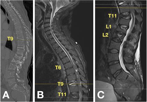 Acute Spinal Cord Compression In The Setting Of Chronic Extramedullary