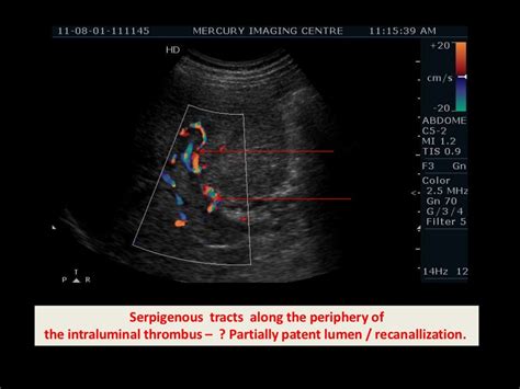 Portal vein thrombosis