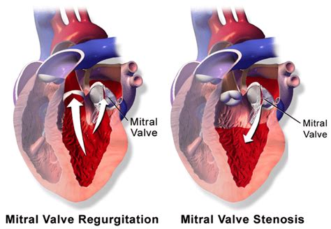 Valvular Disease TeachMeSurgery