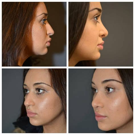 Cout Rhinoplastie Tunisie Estetika Tour