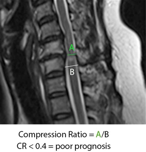 Cervical Myelopathy Spine Orthobullets