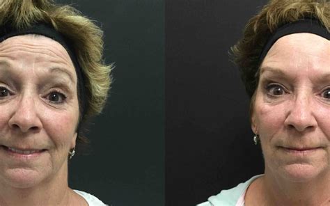 Botox® Before And After Gallery Radiance Medspa