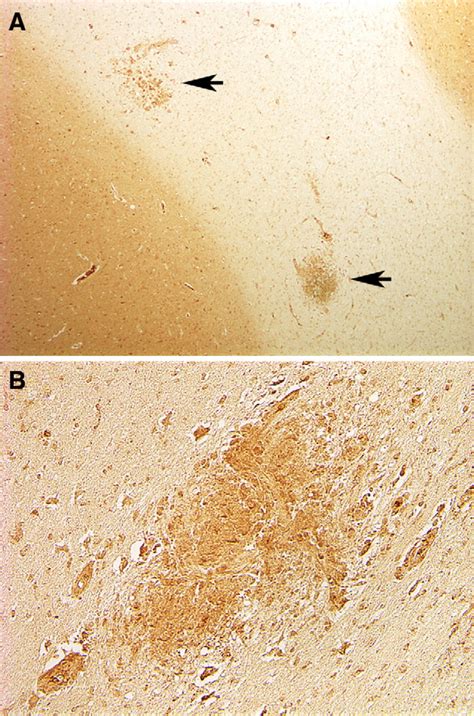 Neurokinin 1 Receptor Nk1 R Expression In The Brains Of Siv Infected