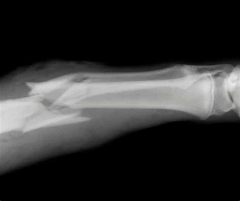 Stages Of Bone Fracture Healing