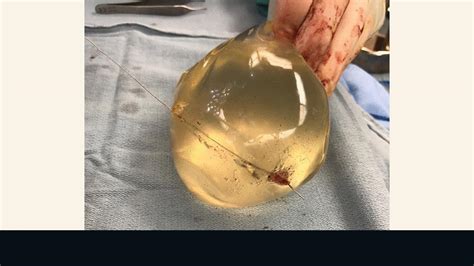 Womans Breast Implant Deflects Bullet Saving Her Life Cnn