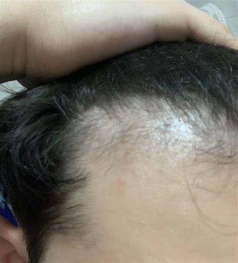 1 Month Results : r/minoxidil