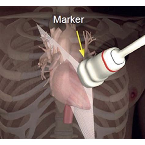 (a) Lung sectors examined: L1 midclavicular line upper chest, L2 ...