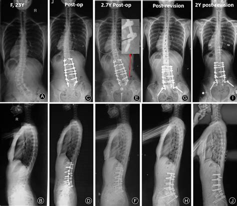 The Patient Was Diagnosed As Cs With L Hemivertebra At Years A