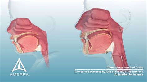 Composite Airway Access Segments 3d Medical Animation Youtube