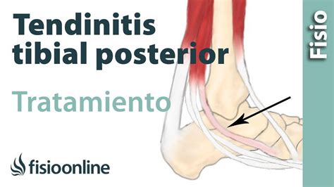 Tendinitis Del Tibial Posterior Qué Es Cuales Son Sus Casuas Y Su