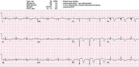 Ecg Cases 14 Q Waves And Occlusion Mi Em Cases