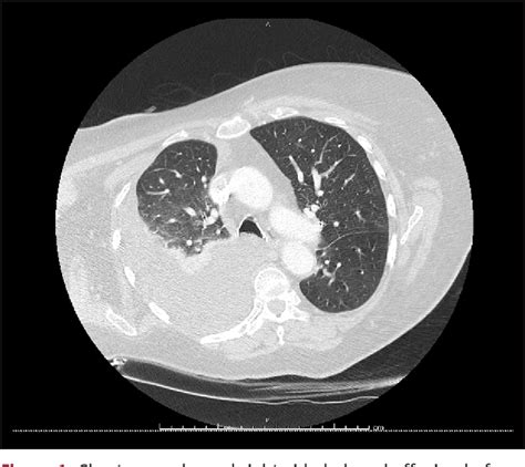 Figure From Recurrent Unilateral Transudative Pleural Effusion Due To