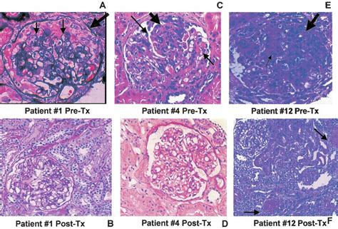 Crescentic Proliferative Iga Nephropathy Clinical And Histological Response To