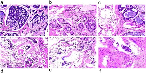 Radiotherapy For Primary Thyroid Adenoid Cystic Carcinoma