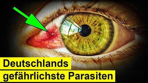 Plötzlich Würmer im Auge So gefährlich sind sie YouTube