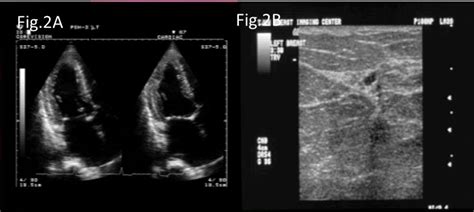 Dicas Para Otimizar A Imagem Ecocardiográfica Bidimensional 2d