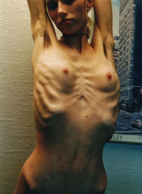 Anorexic Nude 73 Porn Photos