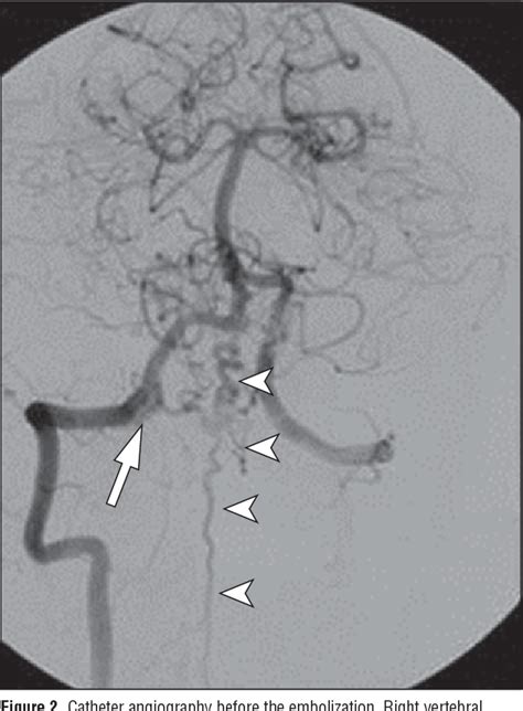 Figure From Dural Arteriovenous Fistula At The Craniocervical