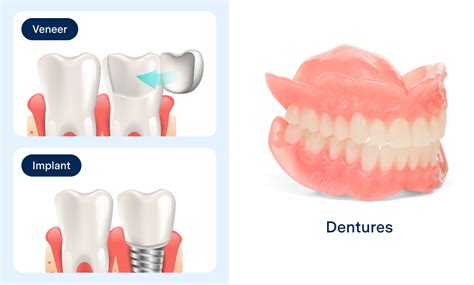 Veneers Vs Dentures Choose The Best Option For Your Smile