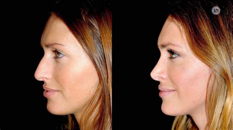 Before And After Photos Rhinoplasty