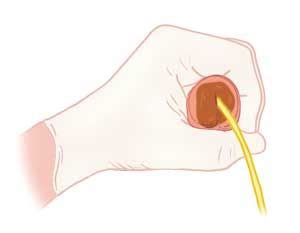 How to MASTER the Foley Catheter Insertion + Advanced Tips & Tricks ...