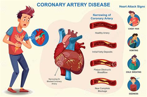 In Coronary Artery Disease, Heart Arteries Become Narrow, Which May ...