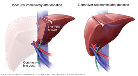 Liver Transplant Mayo Clinic