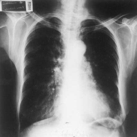 Postero Anterior Chest X Ray Showed Hyperinflation And Bilateral