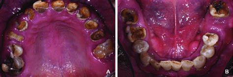 Pretreatment Intraoral Frontal View Of Maxillary And Mandibular Arch