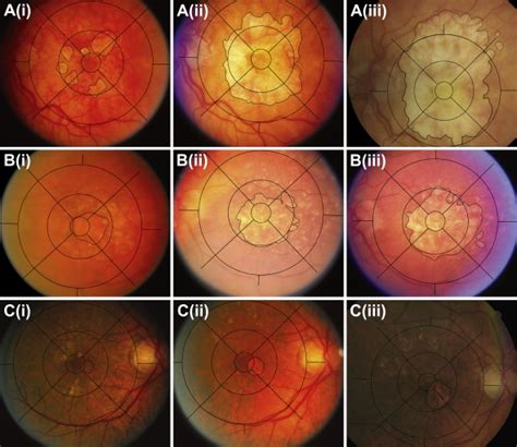 Incidence And Progression Of Geographic Atrophy Ophthalmology