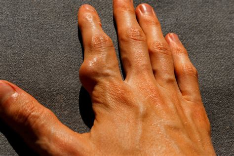 Rheumatoid Arthritis Hands