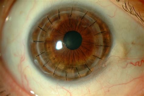 Corneal transplant - Miranza