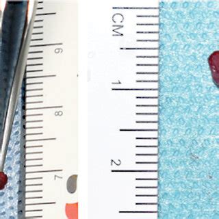 Intraoperative Situs And Hsi Sto After Tef Ligation