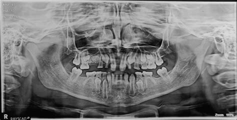 Ectodermal dysplasia: A case report - Adesh University Journal of Medical Sciences & Research