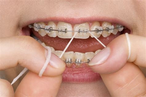 Orthodontics Care And Proper Hygiene Tips For Wearing Braces