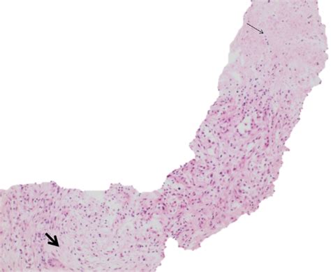 Pathology Pearls Intrahepatic Cholangiocarcinoma Aasld