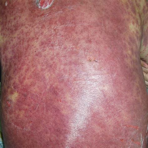 Drug Rash With Eosinophilia And Systemic Symptoms After Erlotinib