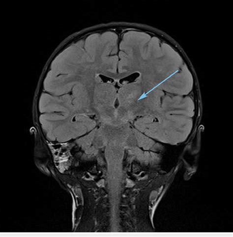 MRI brain T2 coronal FLAIR image showing thalamic and subthalamic ...